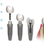Implantology is one of the dental courses provided by GUIDE from SSCDS