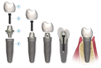 Implantology is one of the dental courses provided by GUIDE from SSCDS